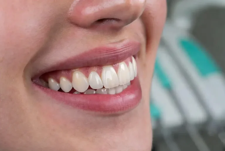 brass smile